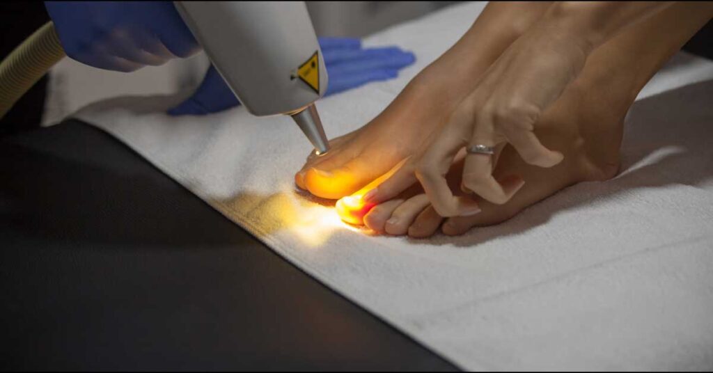 laser za gljivice na noktima